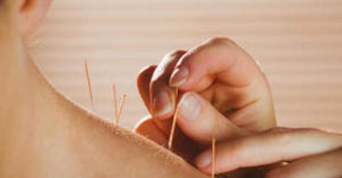 Acupuncture